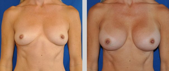Flash Recovery Breast Augmentation TM