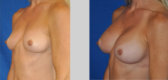 Flash Recovery Breast Augmentation TM