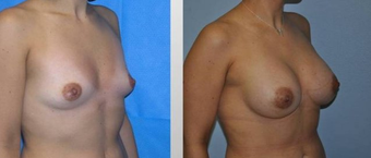 Breast Augmentation 
