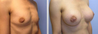 Breast Augmentation 
