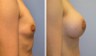 Breast Augmentation 