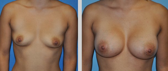 Flash Recovery Breast Augmentation (TM)