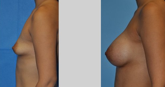 Flash Recovery Breast Augmentation (TM)