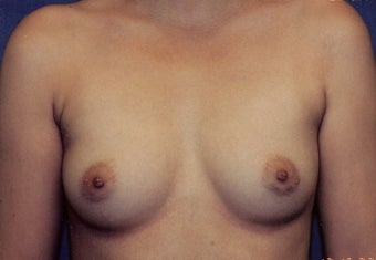 Breast Augmentation