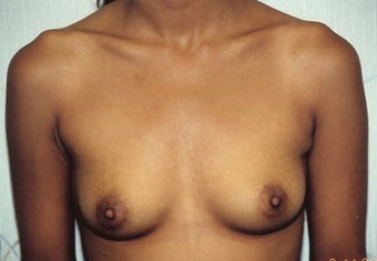 Breast Augmentation