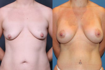Breast Augmentation and Lift
