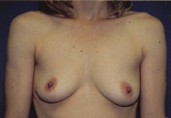 Breast Augmentation