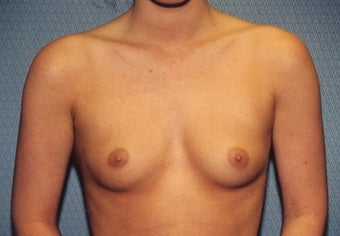 Breast Augmentation