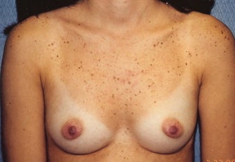 Breast Augmentation