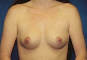 Breast Augmentation
