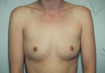 Breast Augmentation