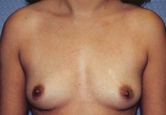 Breast Augmentation