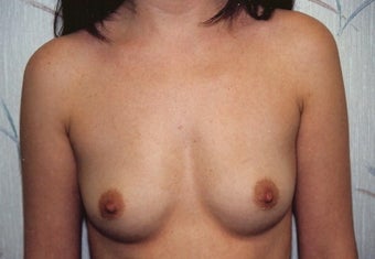 Breast Augmentation