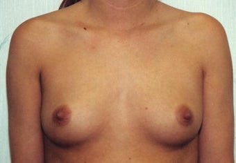 Breast Augmentation