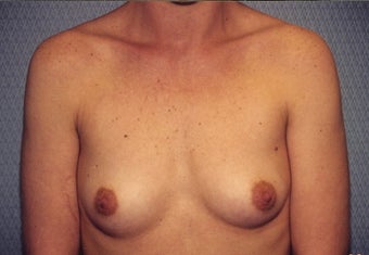 Breast Augmentation