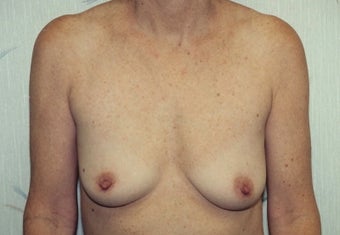 Breast Augmentation