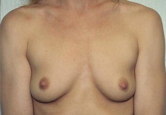 Breast Augmentation