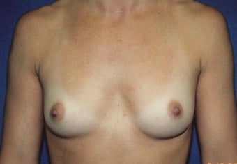 Breast Augmentation
