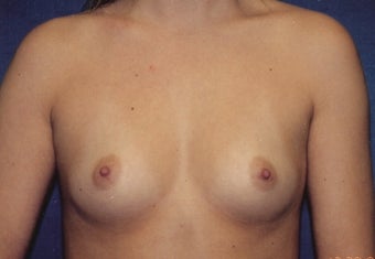 Breast Augmentation