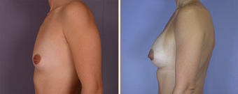 Breast Augmentation 