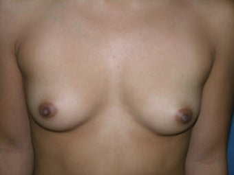 Breast Augmentation