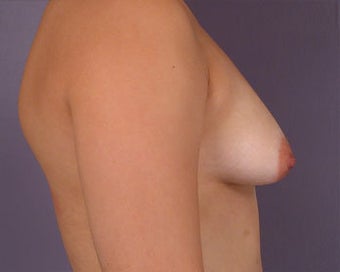 Breast Asymmetry Correction