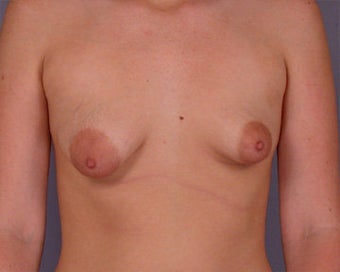 Breast Asymmetry Correction