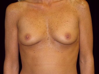 Breast augmentation