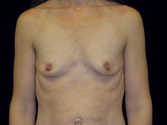 Breast augmentation
