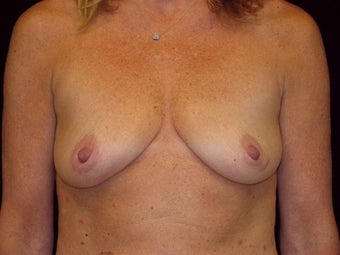 Breast augmentation