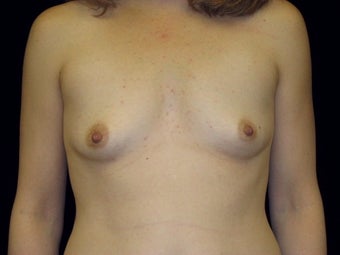 Breast augmentation