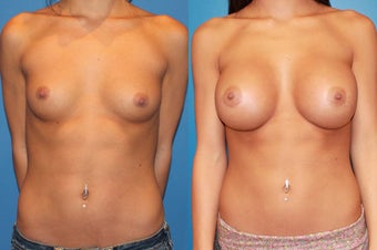 Breast Augmentation