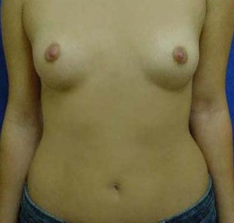 Transaxillary Breast Augmentation 