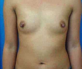Breast Augmentation 