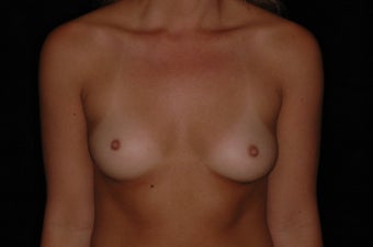 Breast Augmentation