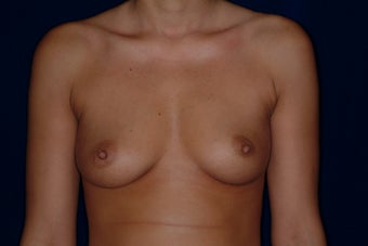 Breast Augmentation