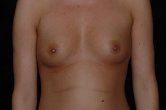 Breast Augmentation