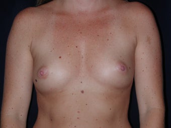 Breast Augmentation
