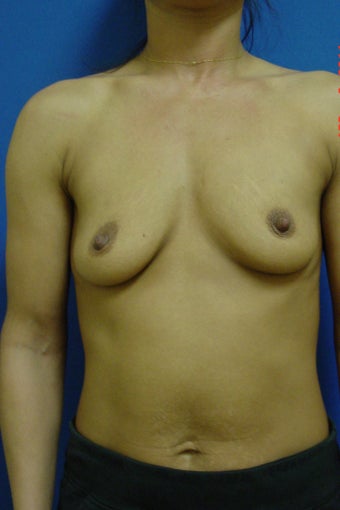 Breast Augmentation