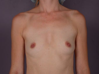 Breast Implants
