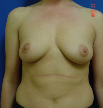 Breast Augmentation
