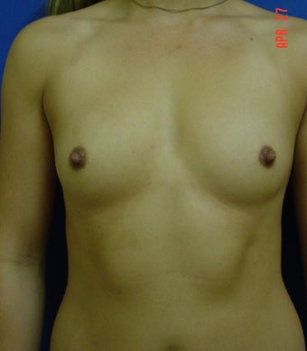 Breast Augmentation