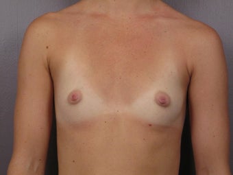 Breast Augmentation