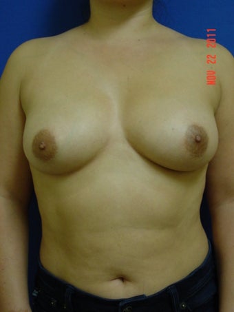 Breast Augmentation