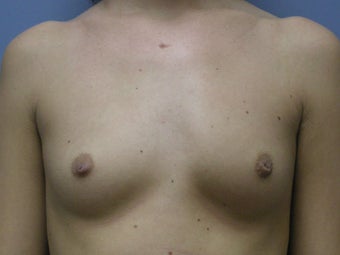 Breast Augmentation