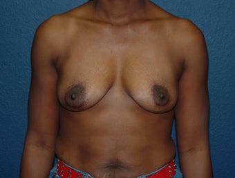 Breast Augmentation