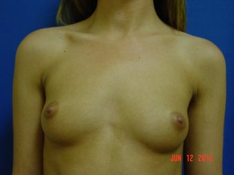 Woman in her mid twenties treated for uneven size and shape