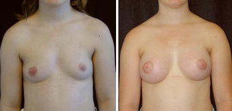 21 year old female, breast augmentation