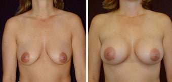 28 year old female, breast augmentation