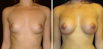 28 year old female, breast augmentation
